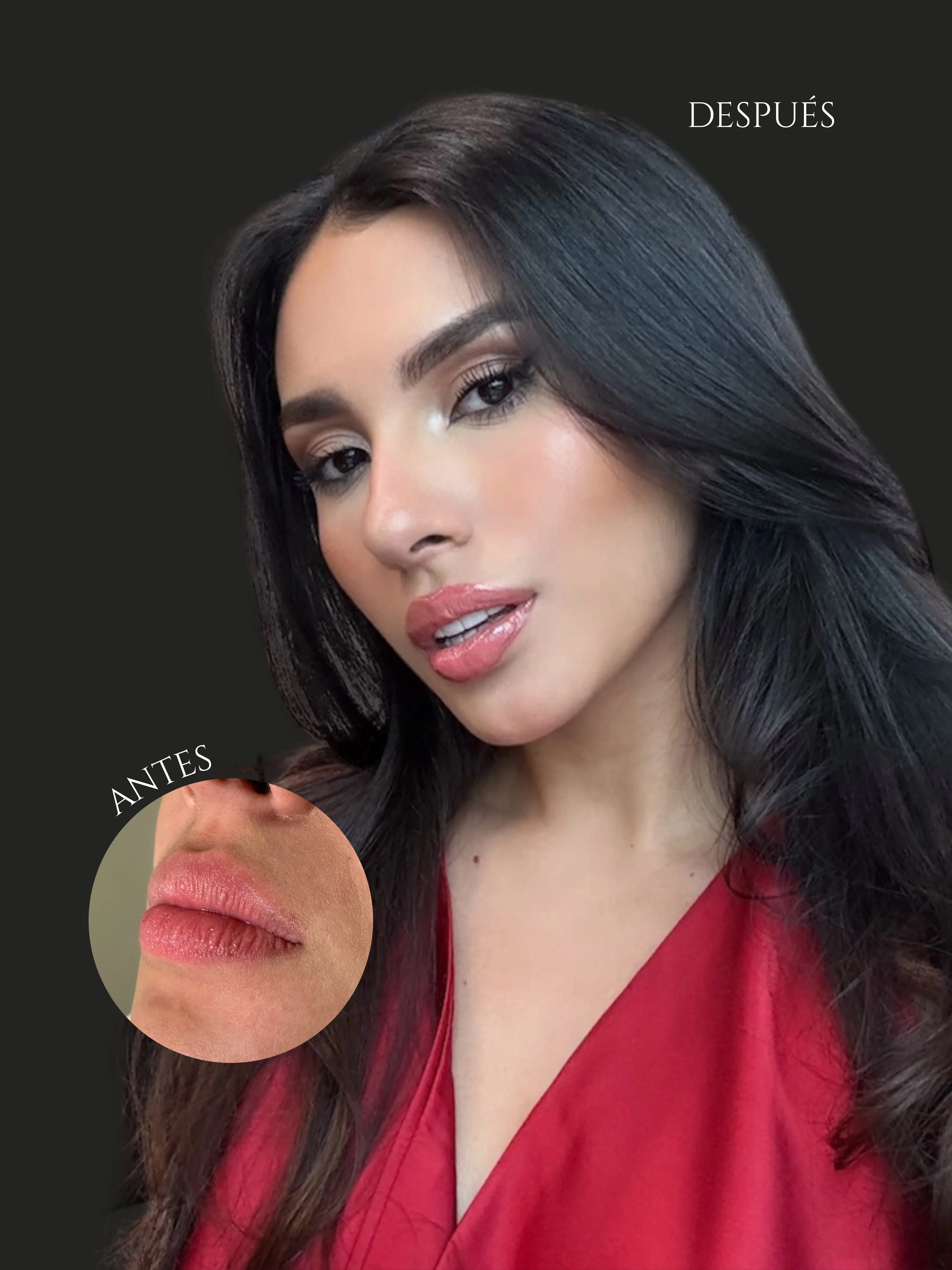 Resultado SS Heart Lips™ — paciente 1