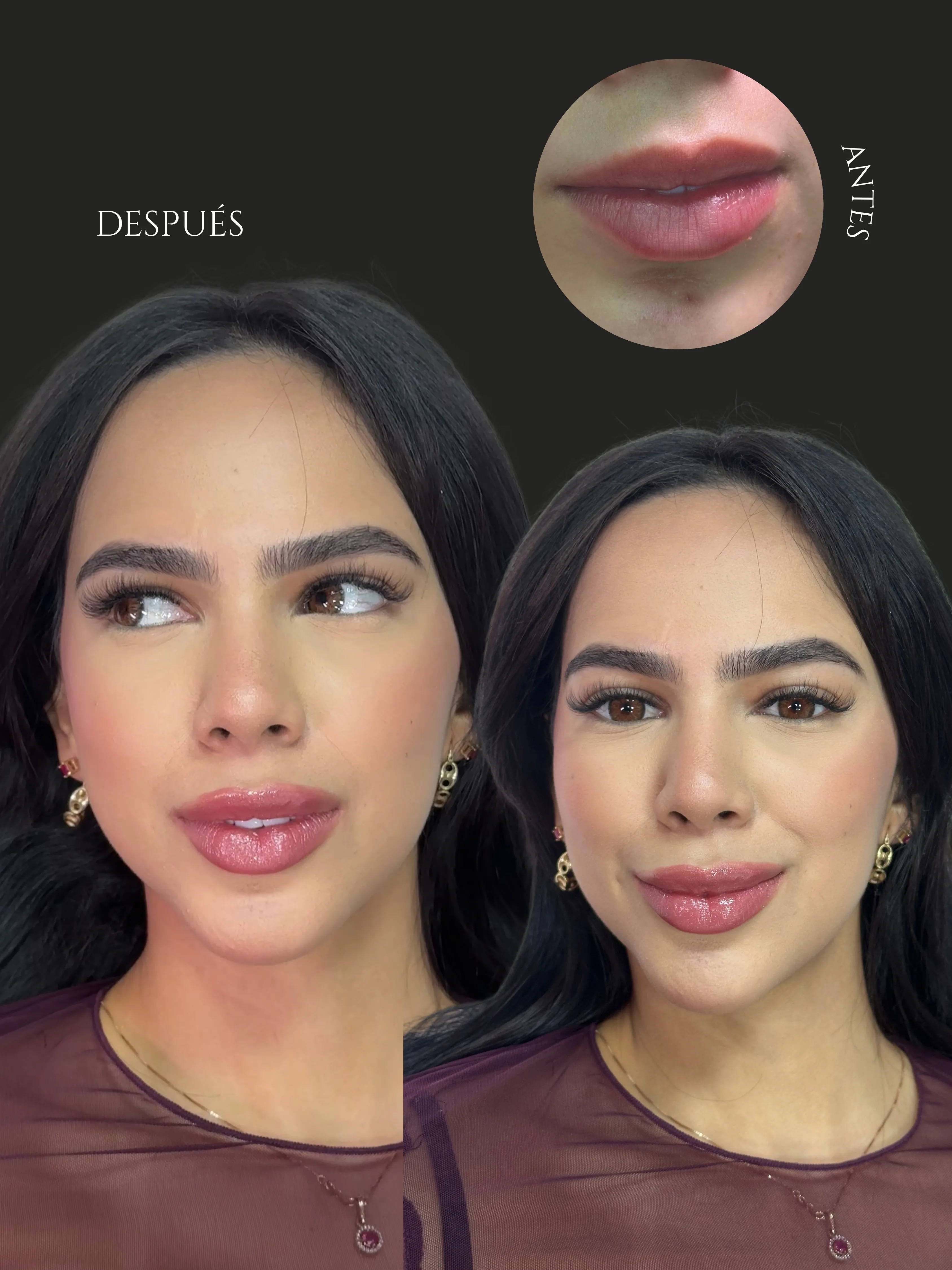 Resultado SS Heart Lips™ — paciente 2