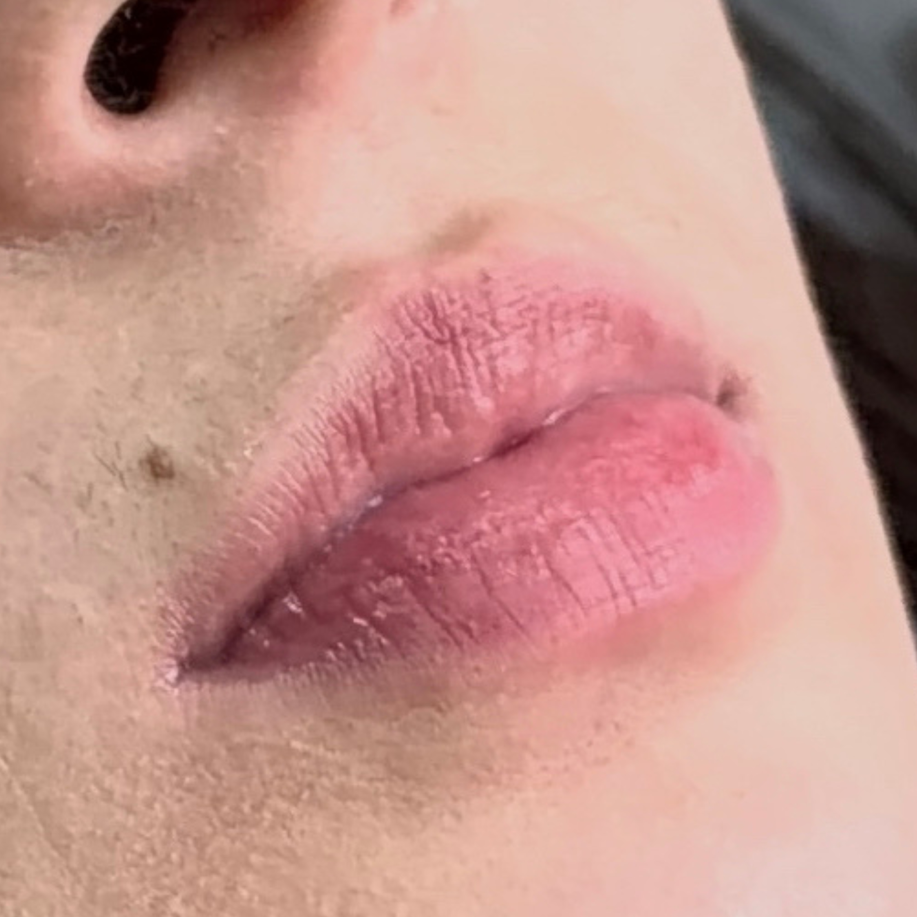 Caso 1 antes SS Heart Lips™ — labios sin relleno