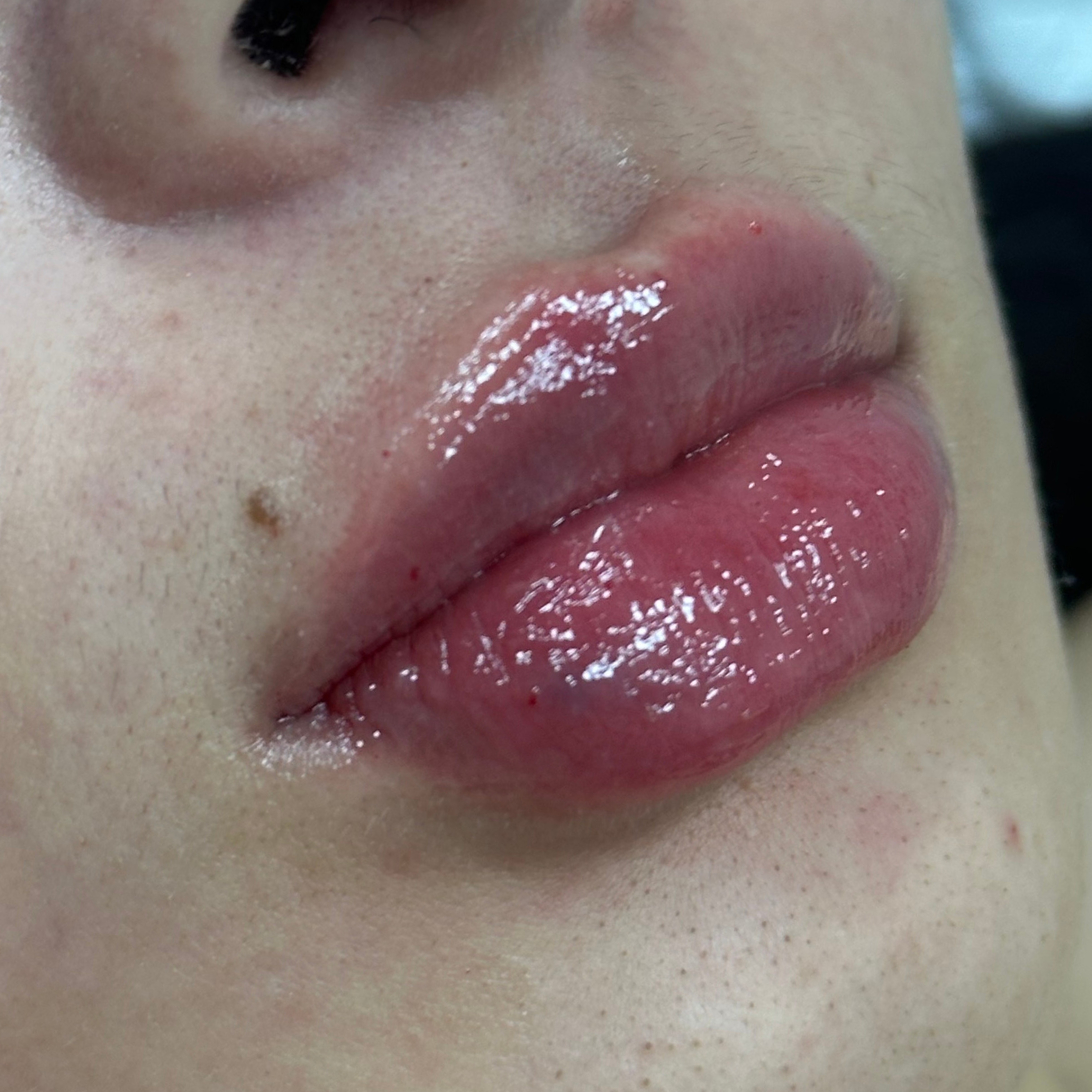 Caso 1 después SS Heart Lips™ — labios con diseño en corazón