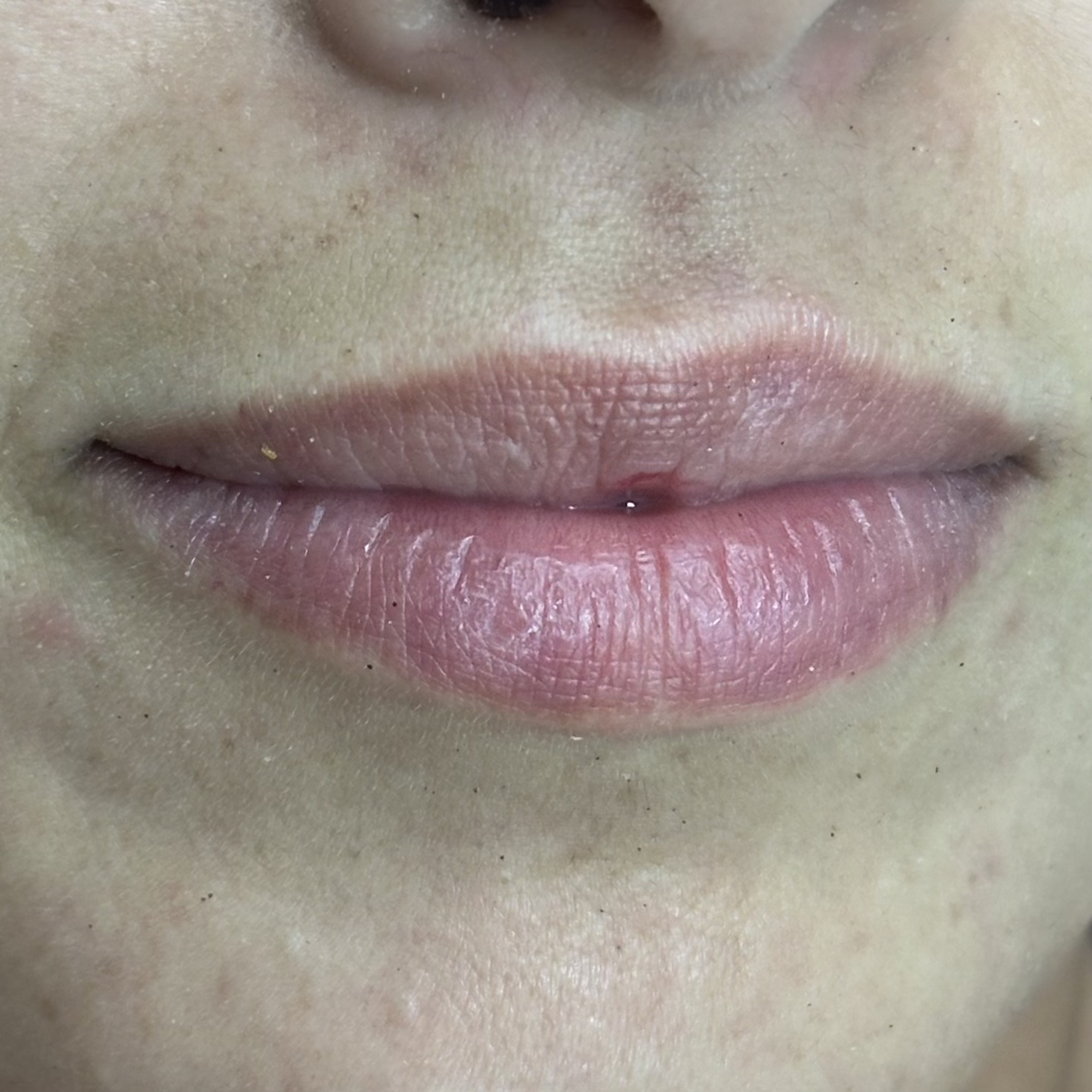 Caso 2 antes SS Heart Lips™