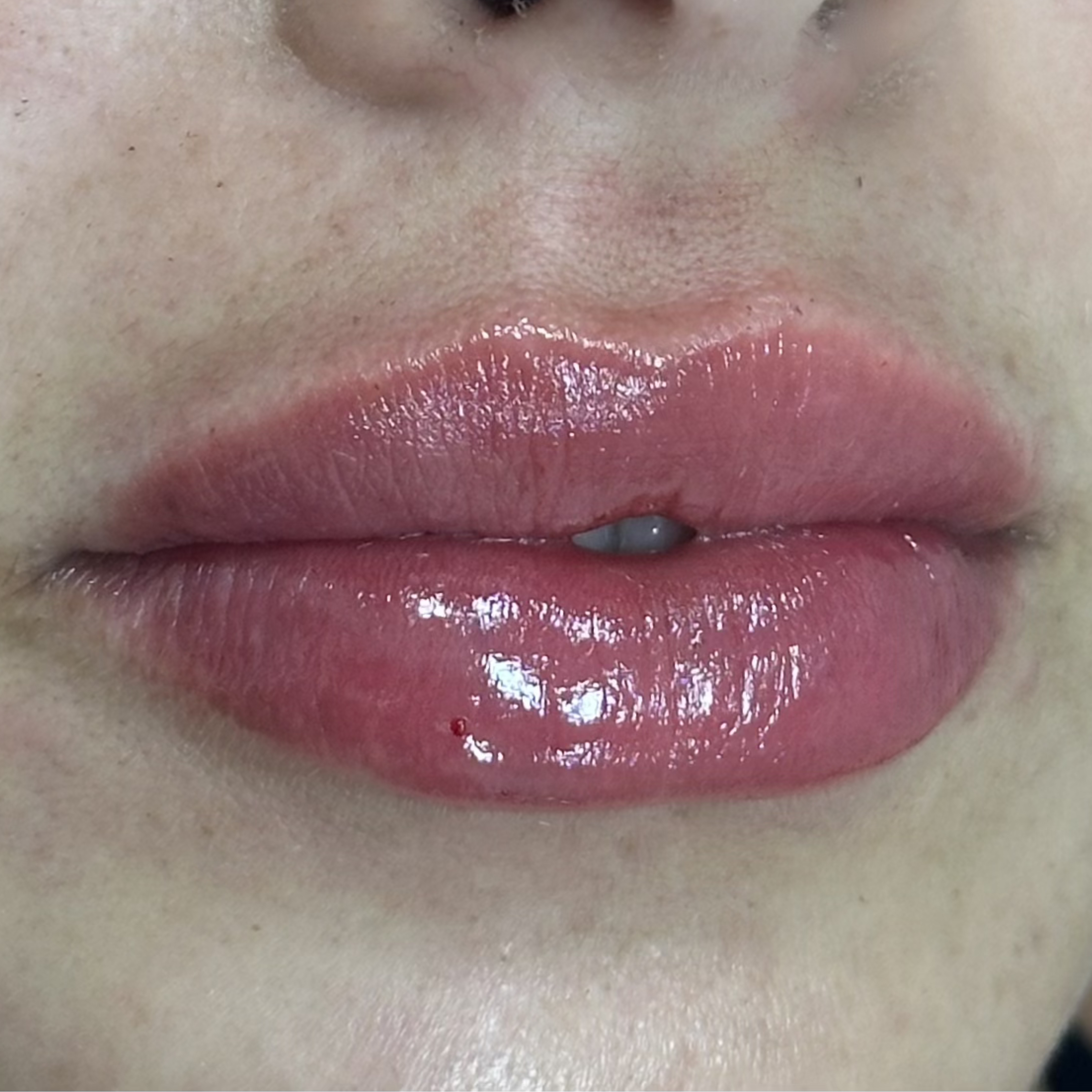 Caso 2 después SS Heart Lips™