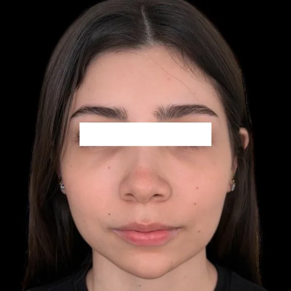 Después de Ojeras