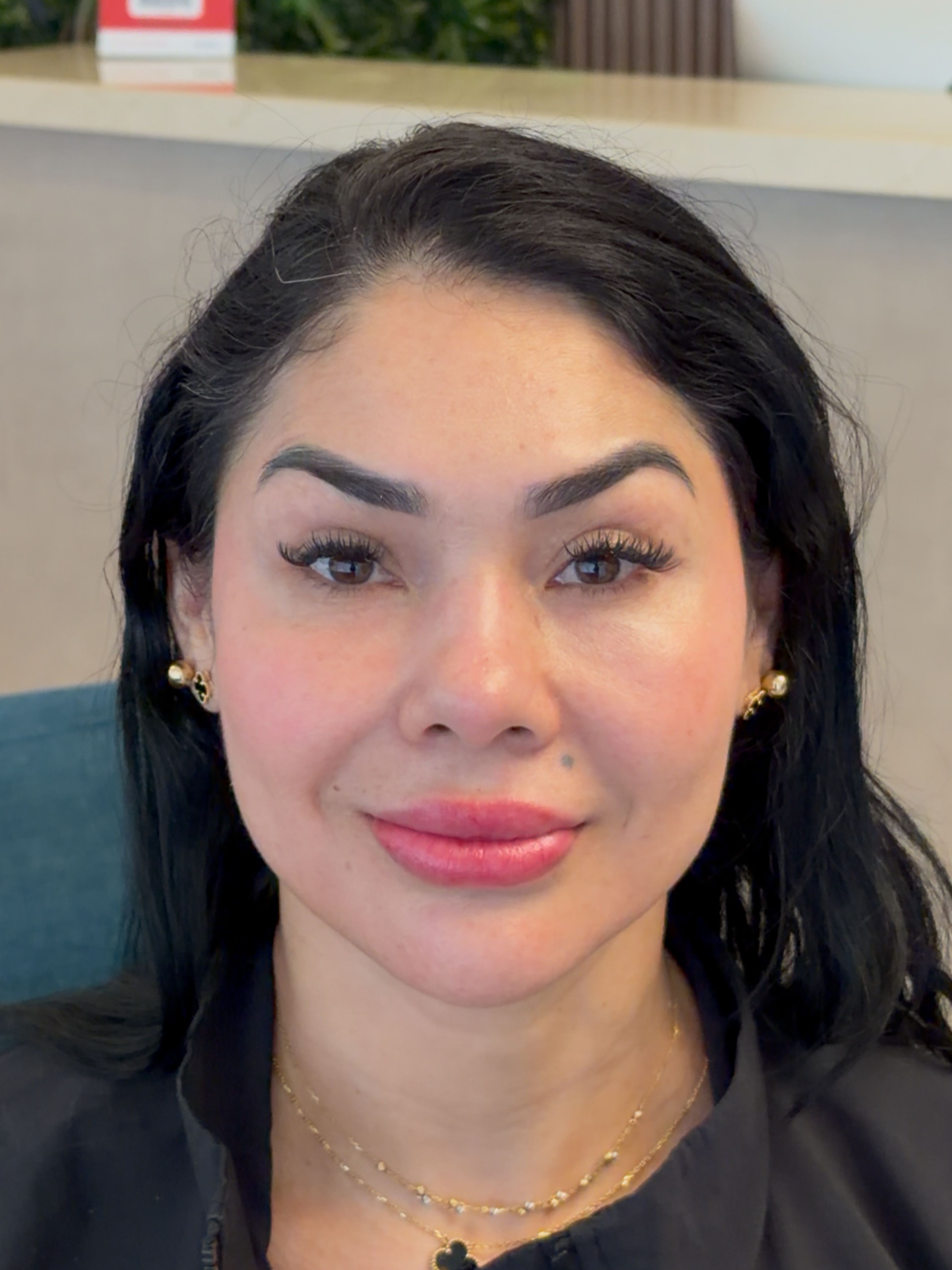 Rosa — después del rejuvenecimiento facial, control 20 días