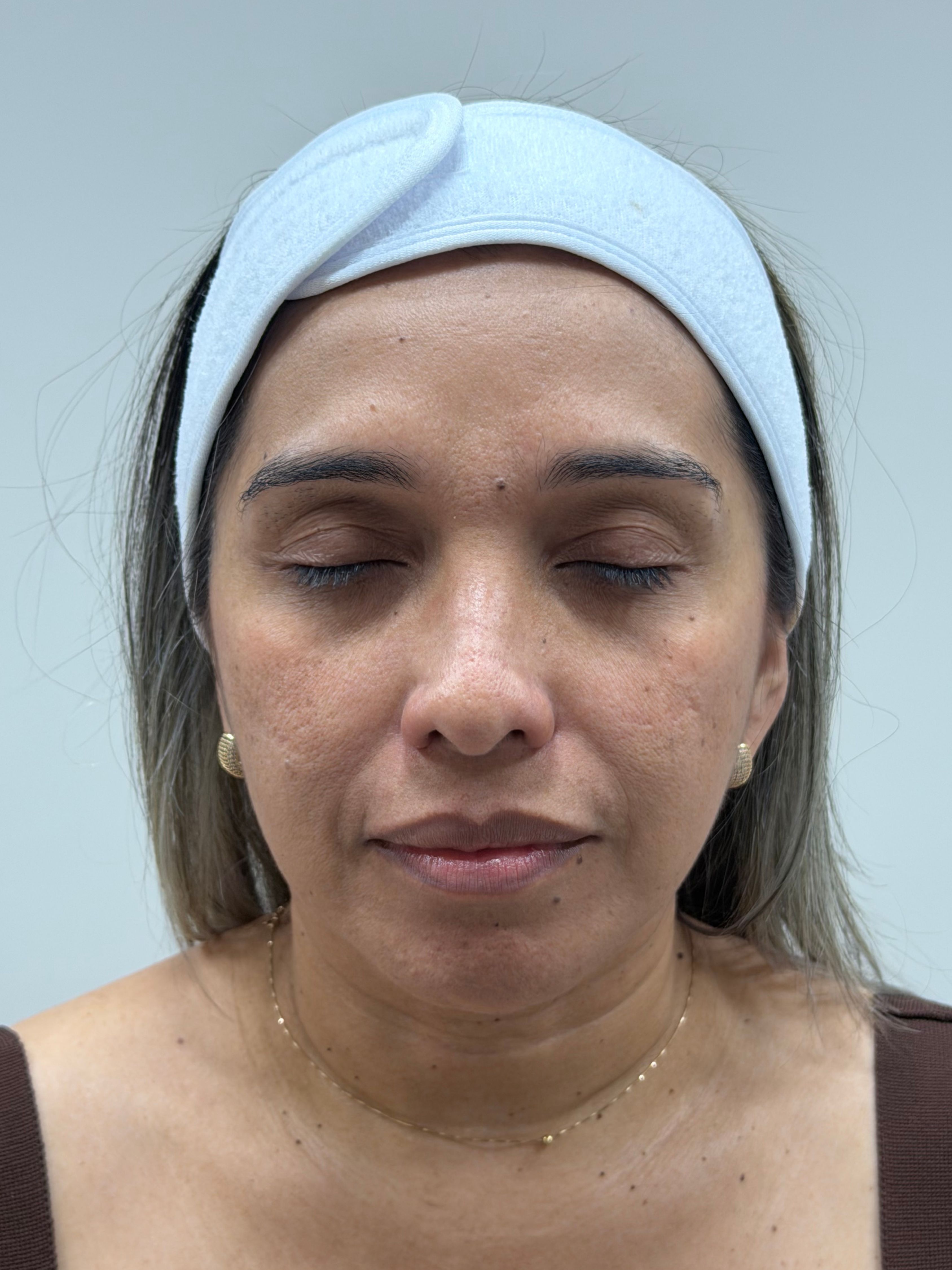 Bibiana — antes del rejuvenecimiento facial