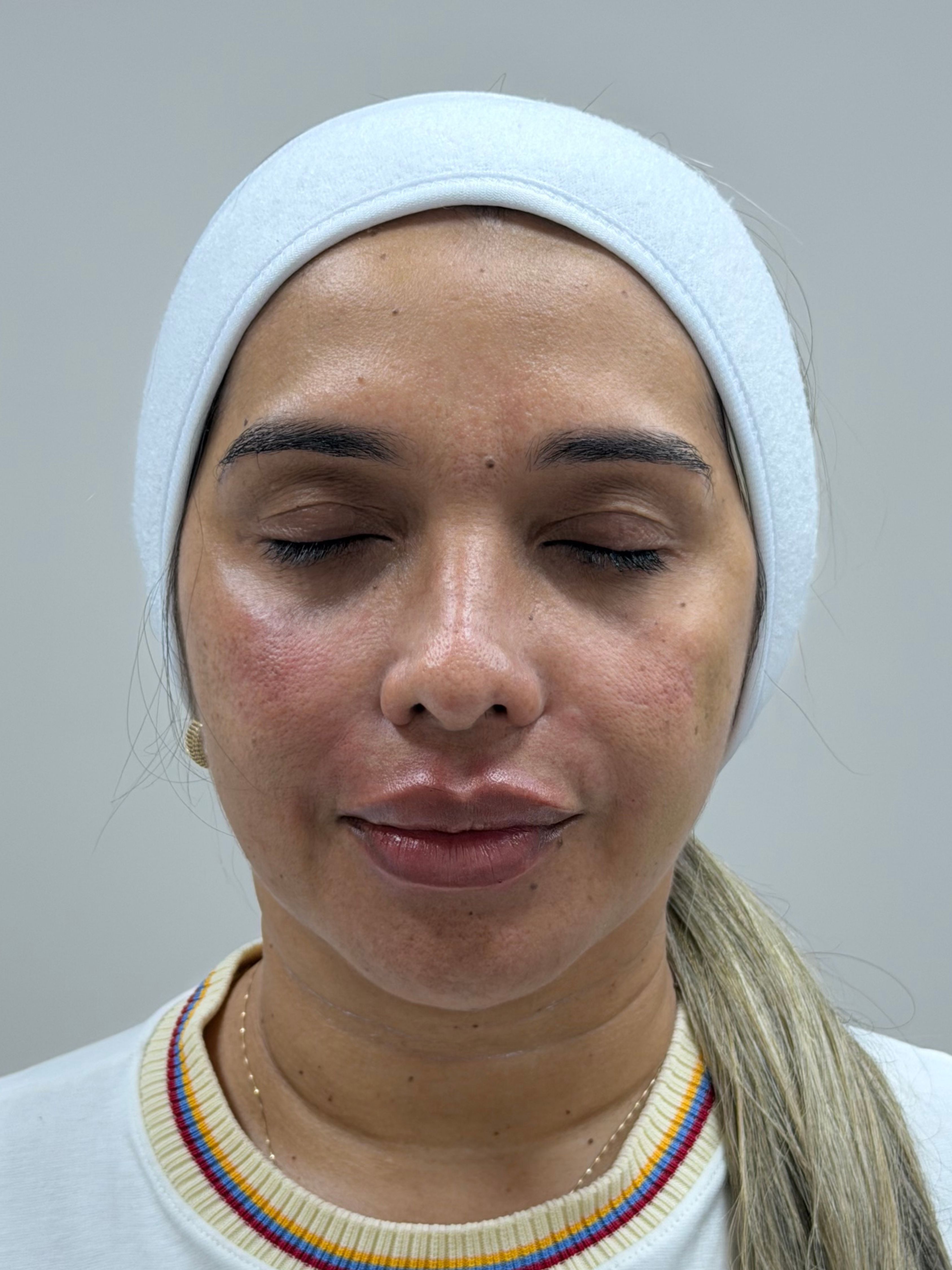 Bibiana — después del rejuvenecimiento facial, control 30 días