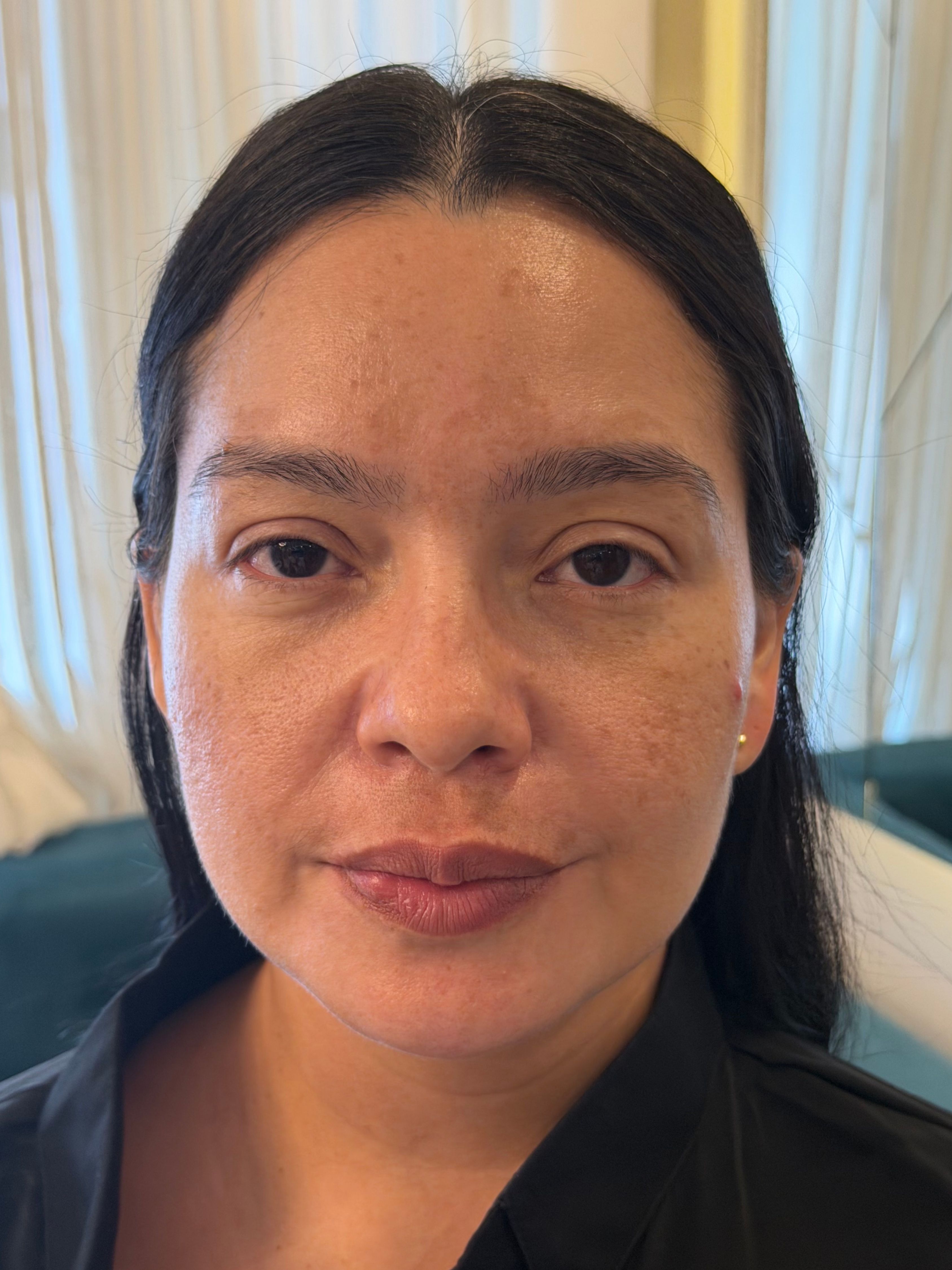 Aida — antes del rejuvenecimiento facial