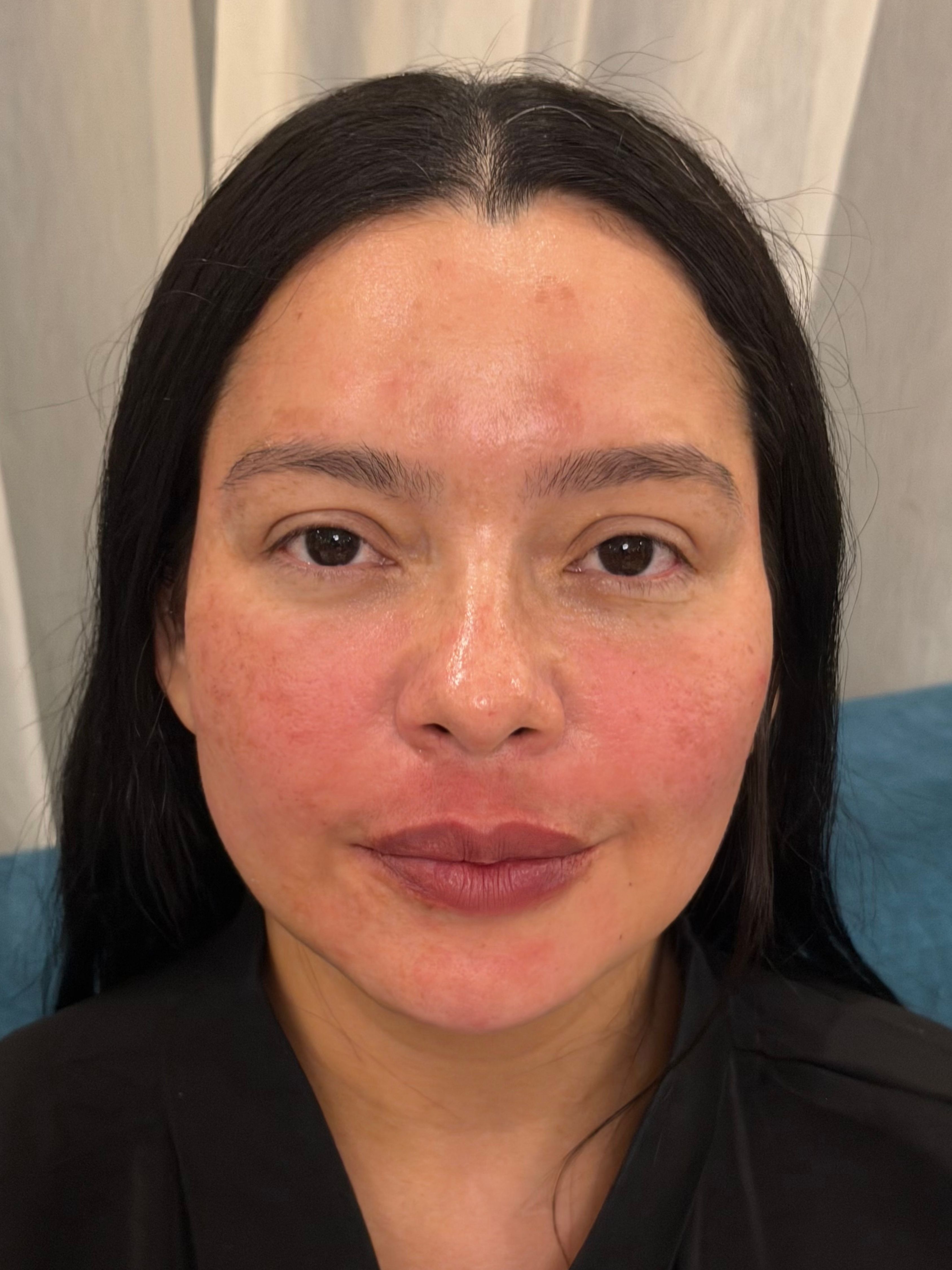 Aida — resultado inmediato del rejuvenecimiento facial