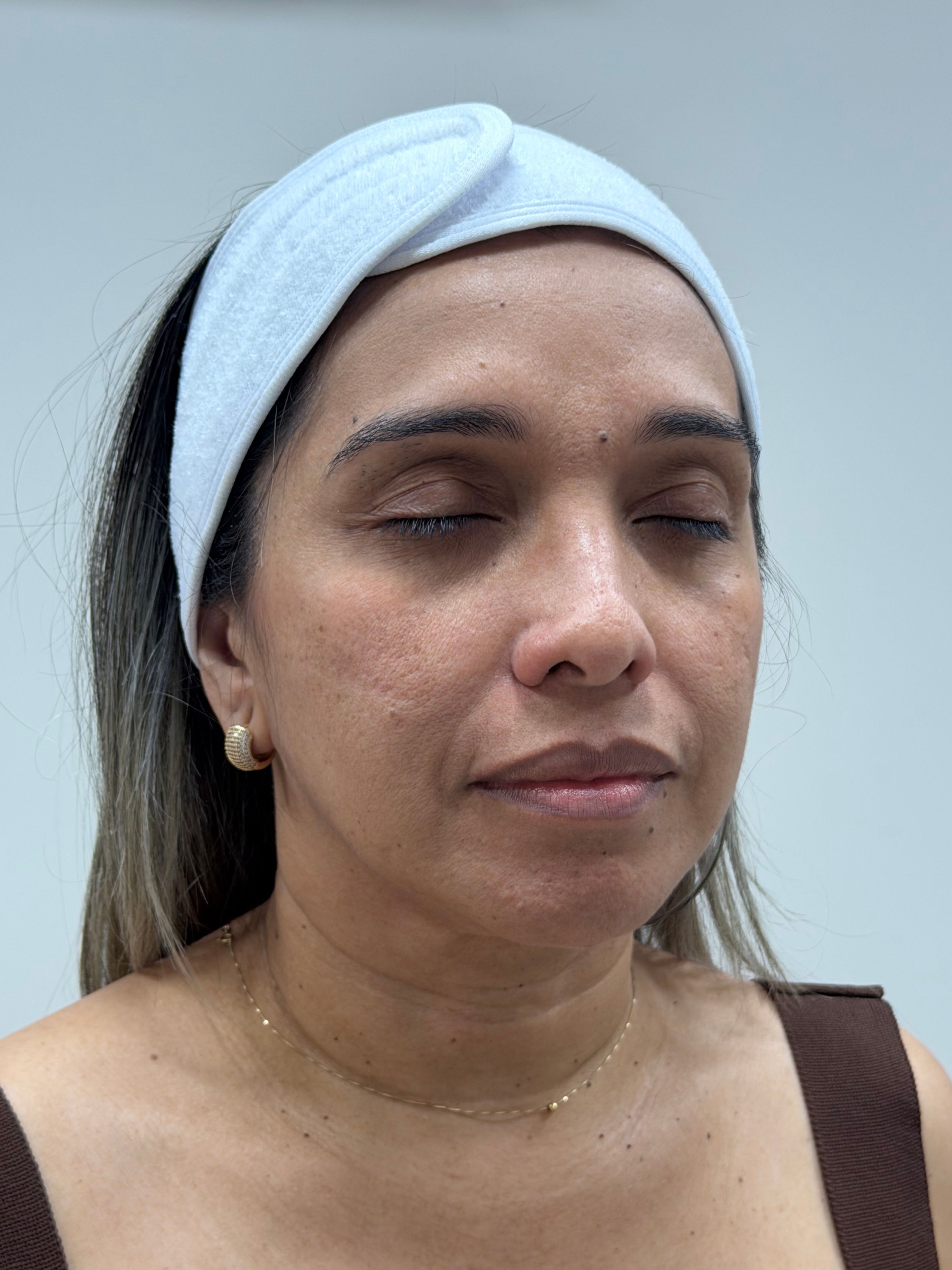 Antes del protocolo de rejuvenecimiento facial