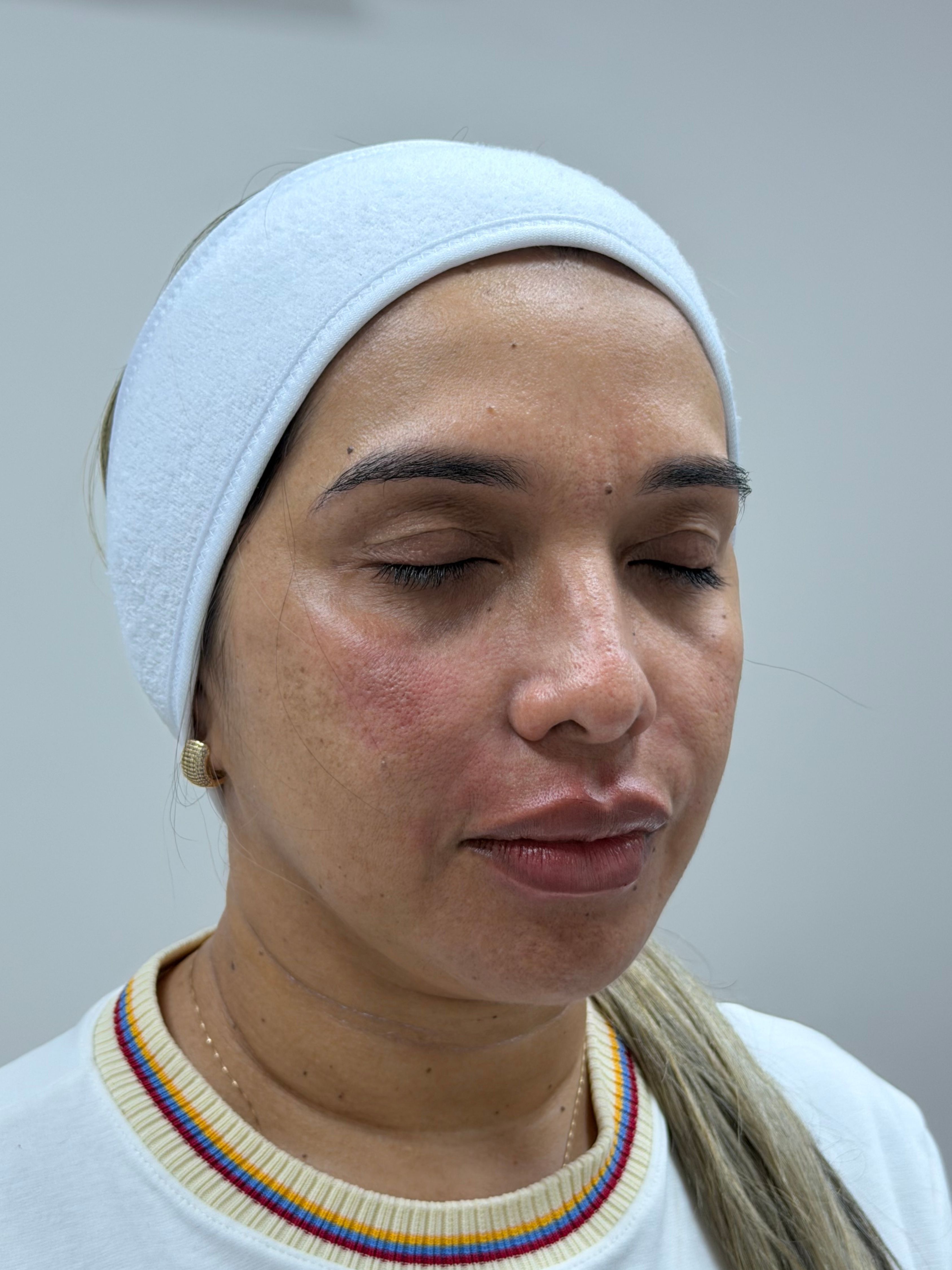 Después del protocolo de rejuvenecimiento facial